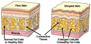 celllulite