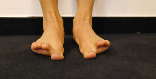 correct flat feet