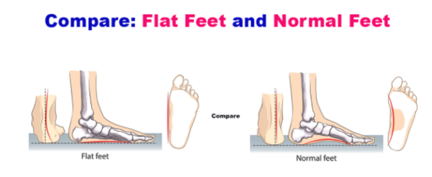 Correct Flat Feet