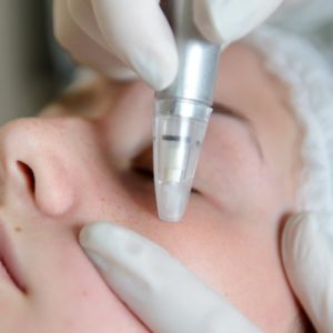 microdermabrasion